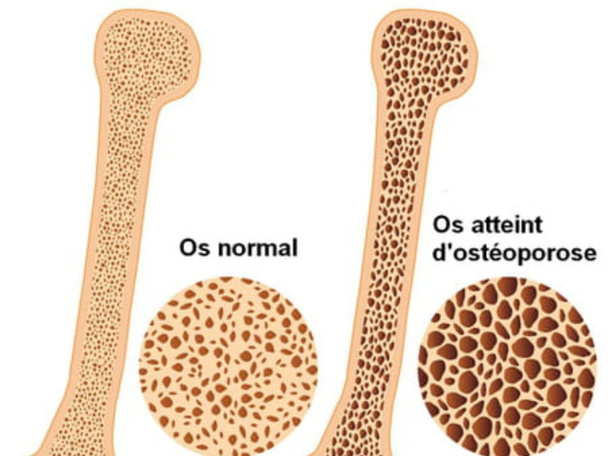 « Mag-Santé » : l’ostéoporose, une maladie répandue chez les personnes du 3e âge