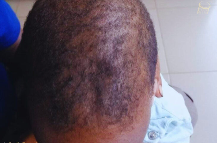 La fontanelle, normale chez les enfants jusqu'à 18 mois