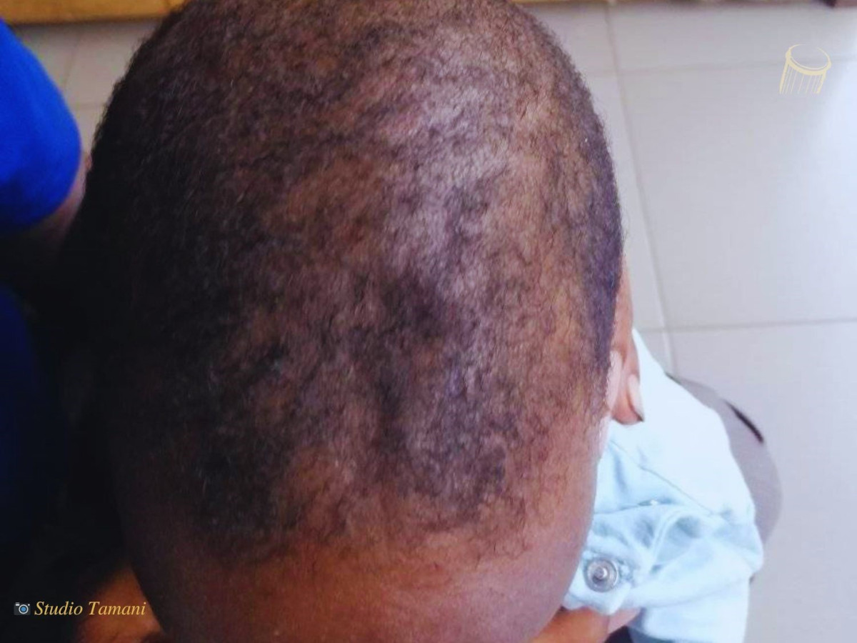 La fontanelle, normale chez les enfants jusqu’à 18 mois