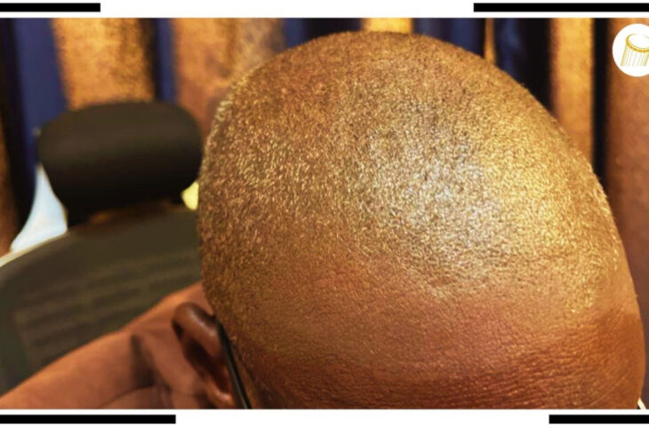 La canitie, un phénomène qui gène des jeunes