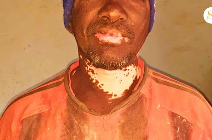 Journée mondiale du vitiligo : briser le silence sur une maladie de peau