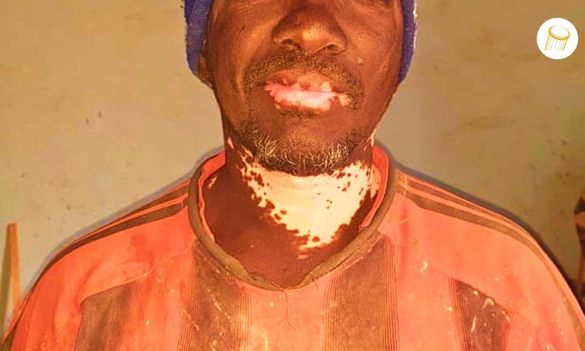 Journée mondiale du vitiligo : briser le silence sur une maladie de peau