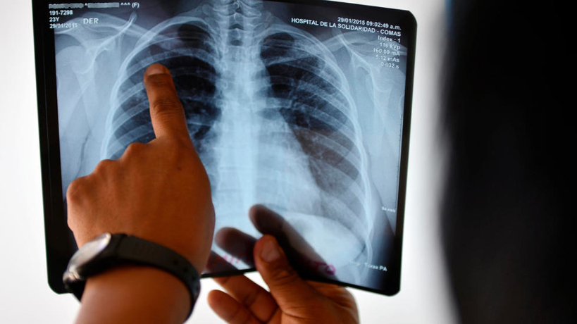 Tuberculose : plus de six mille personnes atteintes au Mali